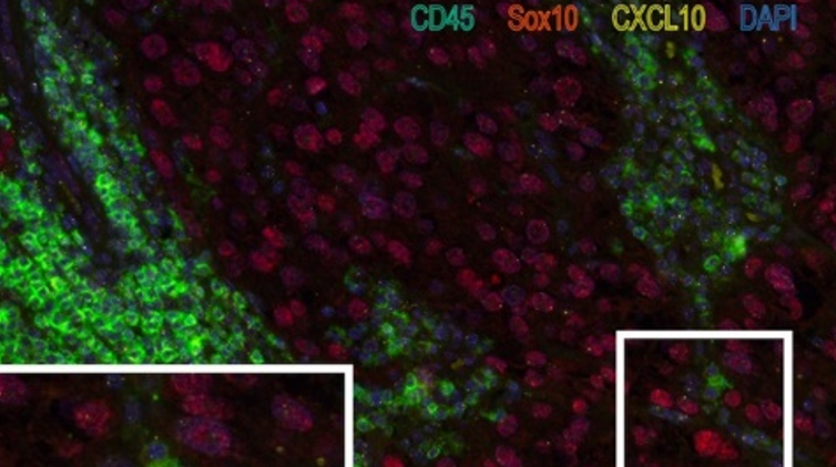 CXCL10 : یک نشانگر امیدوارکننده برای پاسخ ایمونوتراپی در ملانومای متاستاتیک